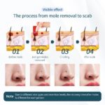 Stylo laser plasma LCD, élimination des taches de rousseur, les grains de beauté et les verrues – Image 7