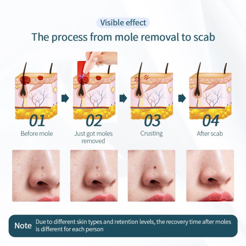 Stylo laser plasma LCD, élimination des taches de rousseur, les grains de beauté et les verrues – Image 7
