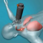 Dispositif de sauvetage anti-étouffement pour adultes et enfants, automatique, kit d'urgence, premiers soins – Image 2