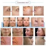 Morpheus 8, appareil de radiofréquence professionnel, microneedling, le soin des stars d'Hollywood – Image 5